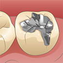 虫歯の治療後